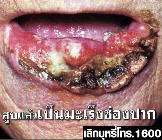 Thailand 2009 Health Effects mouth - diseased organ, oral cancer, gross